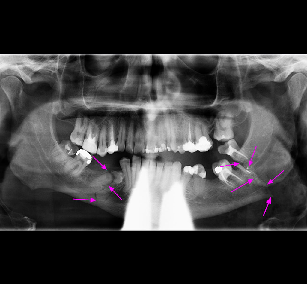 Traumatisme maxillofacial