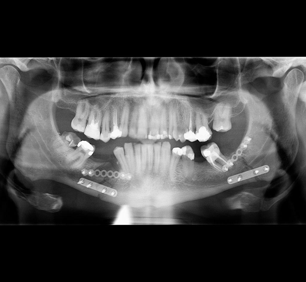 Traumatisme maxillofacial